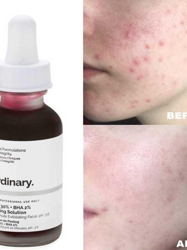 The Ordinary Aha 30% + Bha 2% Peeling Solution 30ml Exfoliante