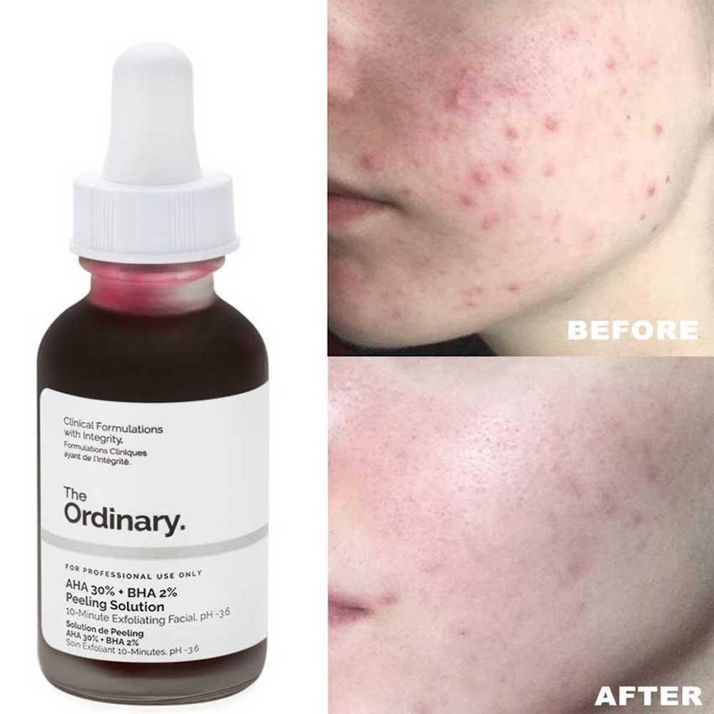 The Ordinary Aha 30% + Bha 2% Peeling Solution 30ml Exfoliante - Imagen 2