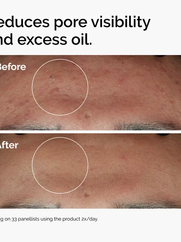 Niacinamide 10%zinc 1%-The Ordinary Niacinamida